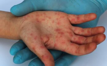 Declara OMS a virus de viruela símica como emergencia sanitaria