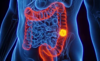 Aumenta cáncer intestinal en jóvenes a nivel global