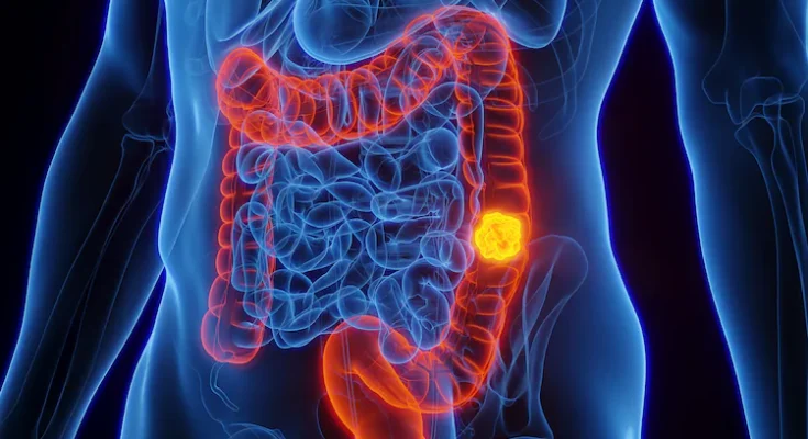 Aumenta cáncer intestinal en jóvenes a nivel global